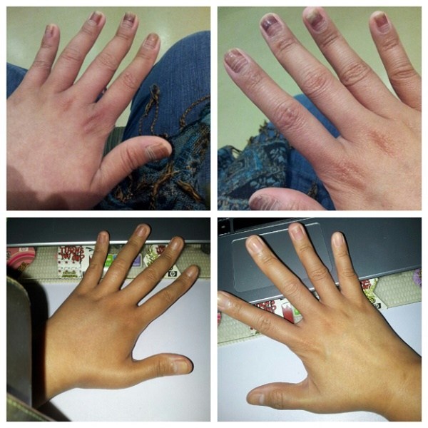 Changes in nails